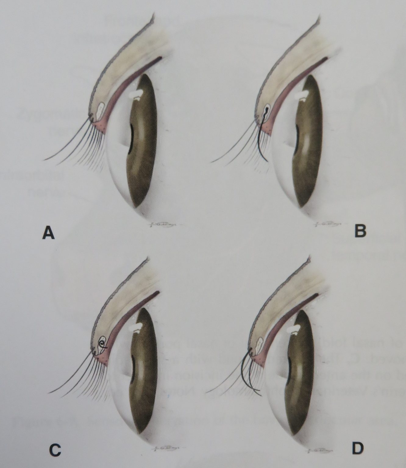 Eyelash Disorders: Distichiasis or Ectopic Cilia or Trichiasis ...